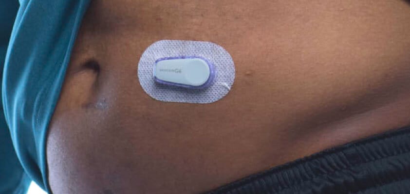 Diyabet için Uzun Ömürlü Sürekli Glukoz Takibi Cihazları (CGM)
