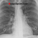 Yeni İlaç Kombinasyonu: Amivantamab ve Lazertinib