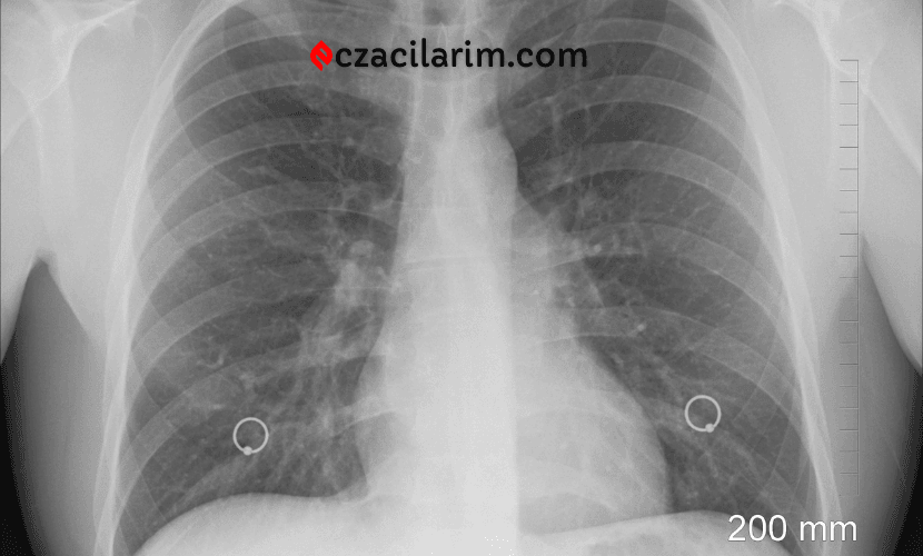 Yeni İlaç Kombinasyonu: Amivantamab ve Lazertinib